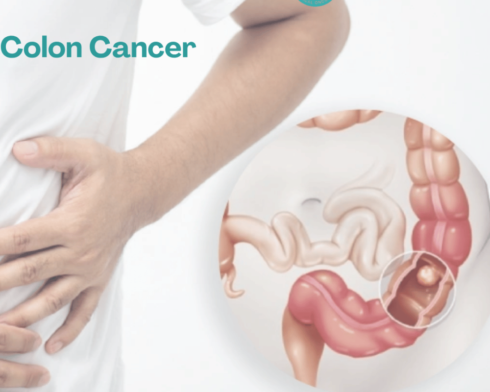 dr-anuj-suketu-shah-trusted-colon-cancer-surgeon-in-ahmedabad