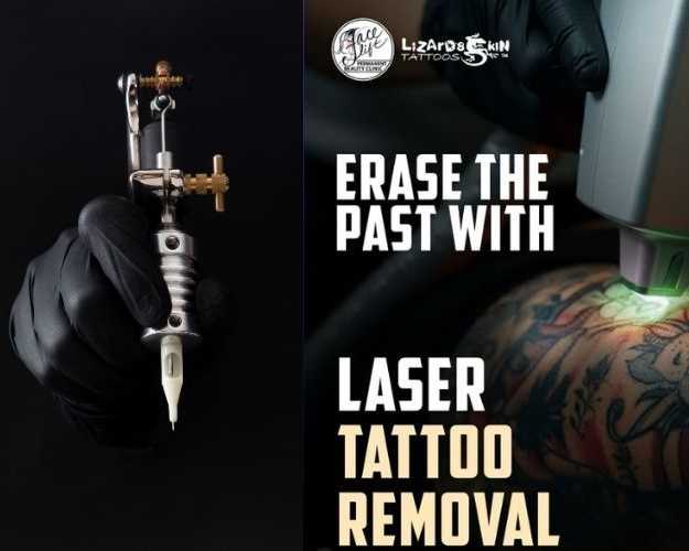 laser-tattoo-removal-in-kolkata-safe-effective