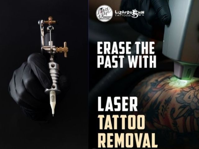 laser-tattoo-removal-in-kolkata-safe-effective