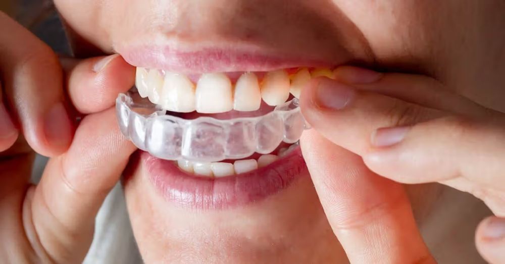 certified-best-invisalign-provider-in-trivandrum-big-0