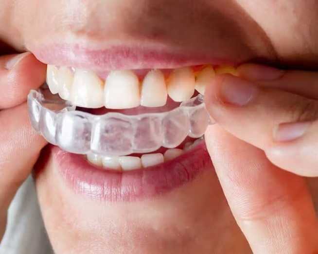 certified-best-invisalign-provider-in-trivandrum