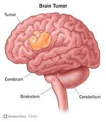 specialized-treatment-for-complex-brain-tumor-conditions-big-0