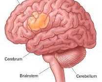 specialized-treatment-for-complex-brain-tumor-conditions