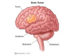specialized-treatment-for-complex-brain-tumor-conditions-small-0
