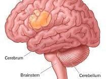 specialized-treatment-for-complex-brain-tumor-conditions