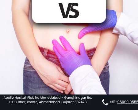 get-rid-of-hernia-safely-with-dr-vishal-sonis-expert-care