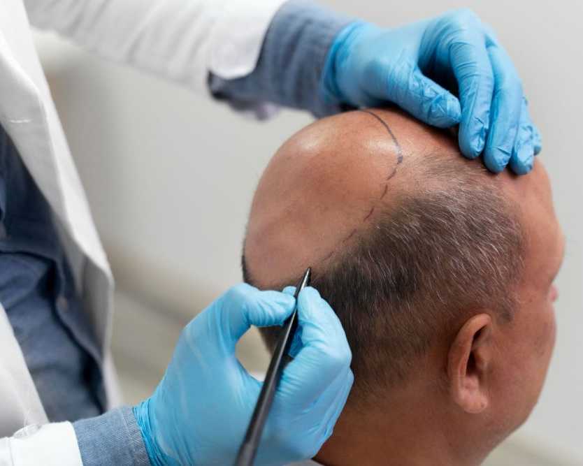 hair-loss-treatment-in-kokapet-shlok-dermatology
