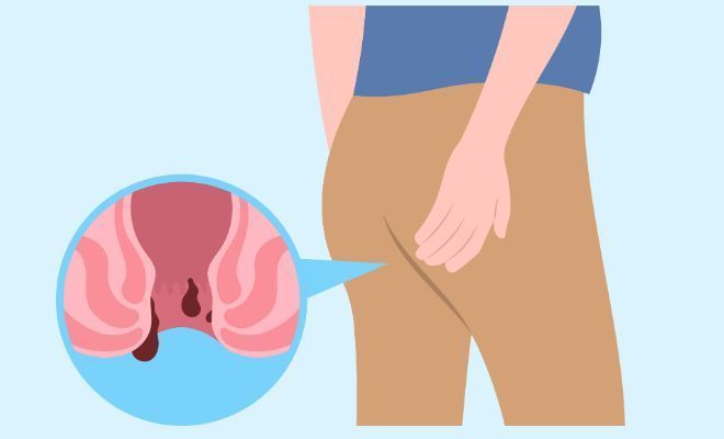 advanced-kshar-sutra-treatment-in-noida-by-expert-doctors-big-0