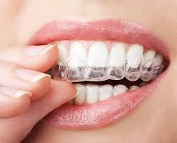 best-aligners-for-teeth-near-me-for-smile-correction-big-0
