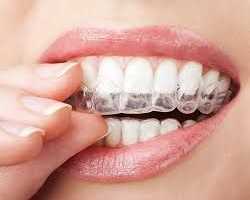 best-aligners-for-teeth-near-me-for-smile-correction