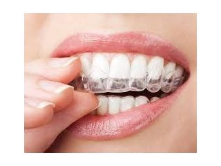 best-aligners-for-teeth-near-me-for-smile-correction-small-0