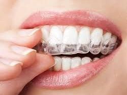 best-aligners-for-teeth-near-me-for-smile-correction
