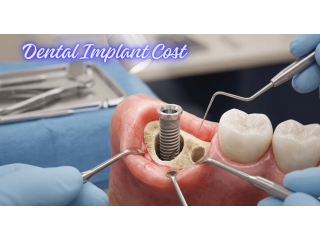 what-really-decides-dental-implant-cost-in-mumbai-small-0