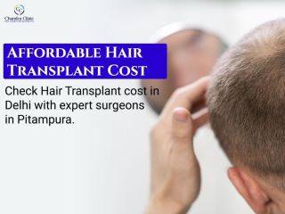 hair-transplant-cost-in-delhi-starting-at-affordable-prices-small-0