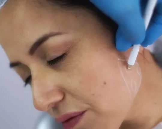 jawline-fillers-explained