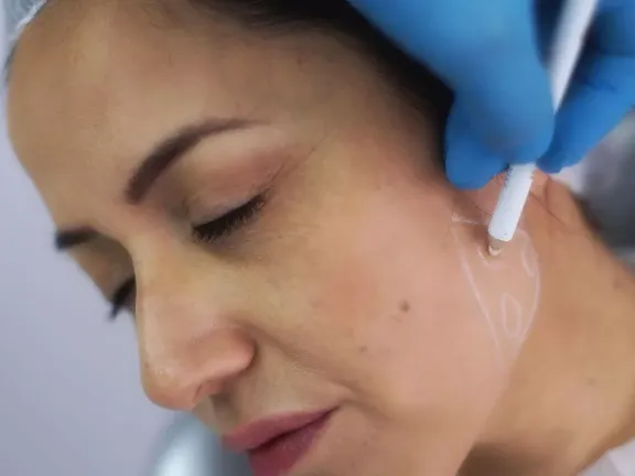jawline-fillers-explained