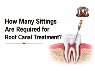 how-many-sittings-are-required-for-root-canal-treatment-small-0