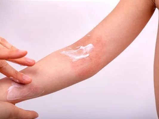 allergic-dermatitis-treatment-expert-skin-care-solutions