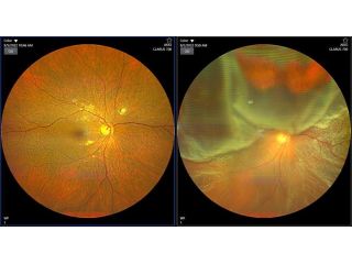 retina-specialist-in-delhi-expert-care-for-clear-vision-in-delhi-small-0