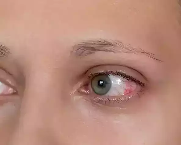 glaucoma-the-silent-thief-of-sight
