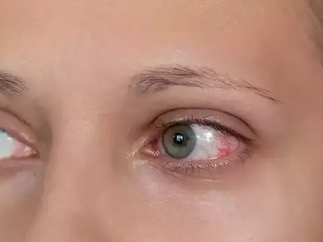 glaucoma-the-silent-thief-of-sight