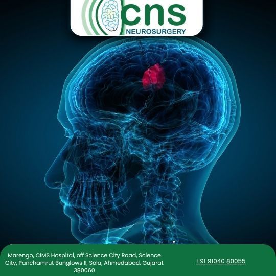 dr-chirag-solanki-trusted-brain-tumor-surgery-in-ahmedabad-big-0
