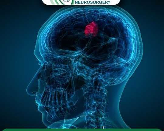 dr-chirag-solanki-trusted-brain-tumor-surgery-in-ahmedabad
