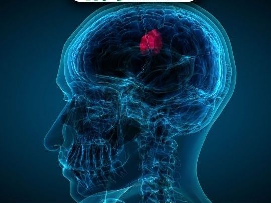 dr-chirag-solanki-trusted-brain-tumor-surgery-in-ahmedabad