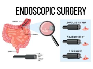 when-endoscopy-is-recommended-for-digestive-problems-small-0