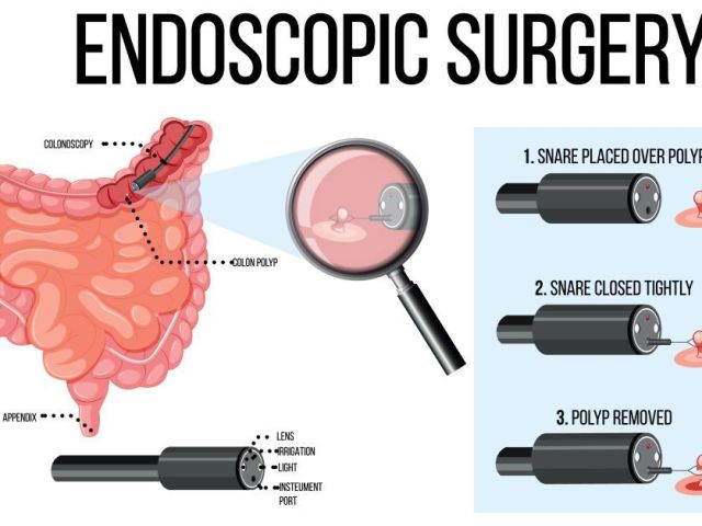when-endoscopy-is-recommended-for-digestive-problems