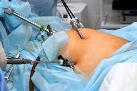 laparoscopic-hernia-surgery-in-kolkata-big-0