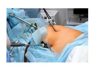 laparoscopic-hernia-surgery-in-kolkata-small-0