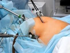laparoscopic-hernia-surgery-in-kolkata