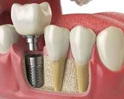 best-dental-implant-clinic-in-chetla-kolkata