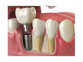 best-dental-implant-clinic-in-chetla-kolkata-small-0