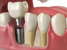 best-dental-implant-clinic-in-chetla-kolkata
