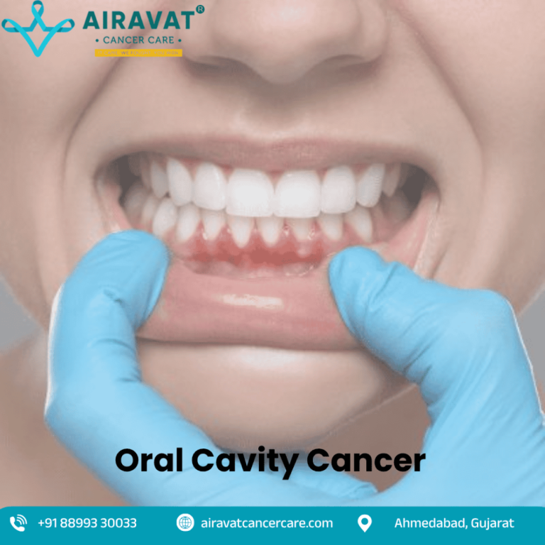 oral-cavity-cancer-treatment-in-ahmedabad-big-0