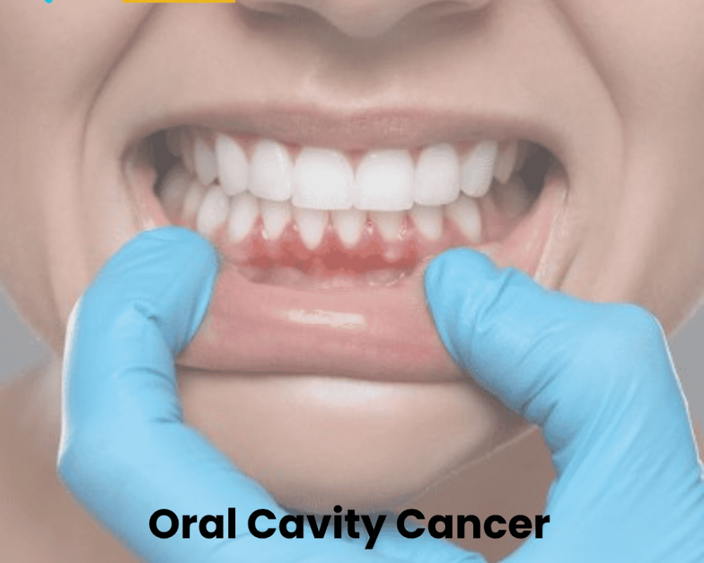 oral-cavity-cancer-treatment-in-ahmedabad