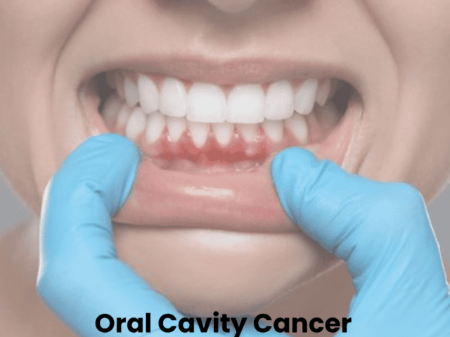 oral-cavity-cancer-treatment-in-ahmedabad