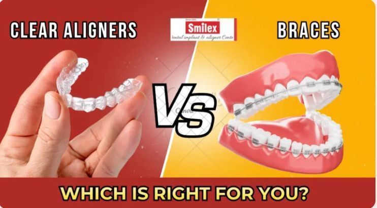 clear-aligners-cost-vs-braces-cost-in-india-detailed-comparison-big-0