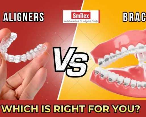 clear-aligners-cost-vs-braces-cost-in-india-detailed-comparison