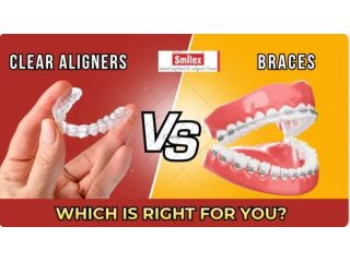 clear-aligners-cost-vs-braces-cost-in-india-detailed-comparison-small-0