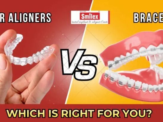 clear-aligners-cost-vs-braces-cost-in-india-detailed-comparison
