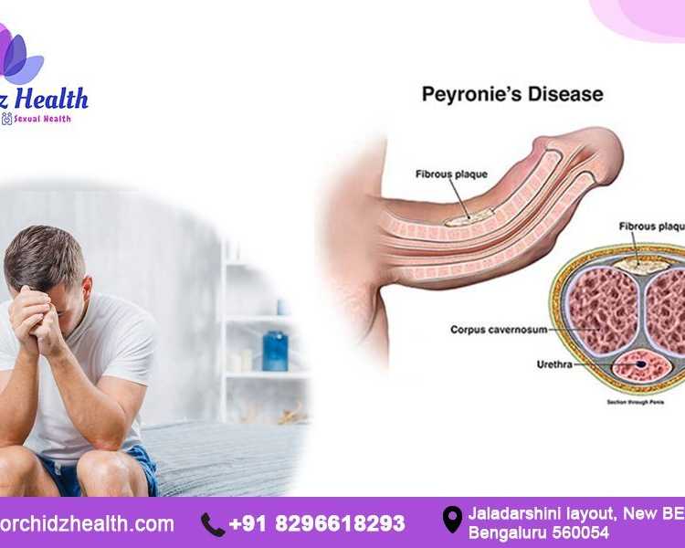 effective-treatments-for-penile-curvature-orchidz-health