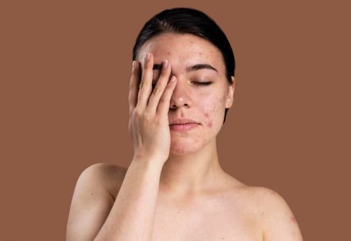 trusted-acne-clinic-in-greater-noida-west-dermalinks-clinic-big-0