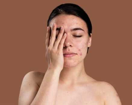 trusted-acne-clinic-in-greater-noida-west-dermalinks-clinic