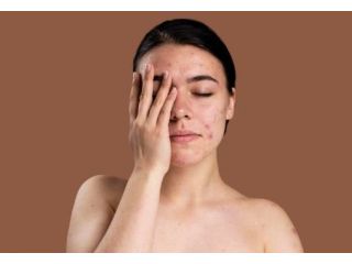 trusted-acne-clinic-in-greater-noida-west-dermalinks-clinic-small-0