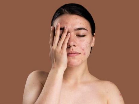 trusted-acne-clinic-in-greater-noida-west-dermalinks-clinic
