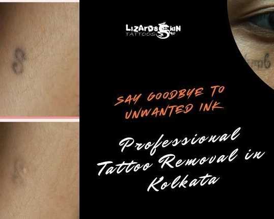 tattoo-removal-in-kolkata-safe-laser-removal-experts