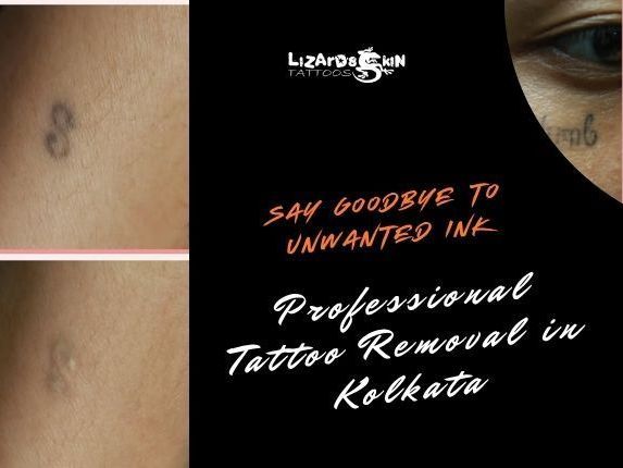 tattoo-removal-in-kolkata-safe-laser-removal-experts